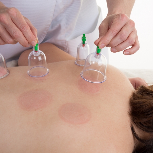 Cupping-Elite-Physical-Therapy-and-Sports-Performance-Traverse-City-MI