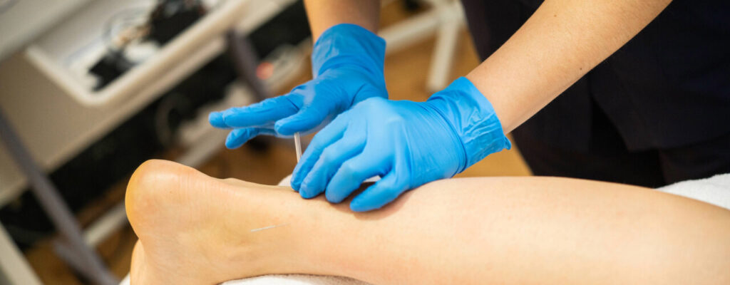 Combining Dry Needling with Physical Therapy: A Powerful Duo for Recovery